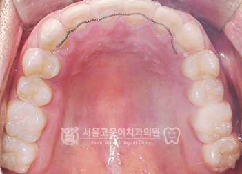 소구치 공간 확보 사례 after